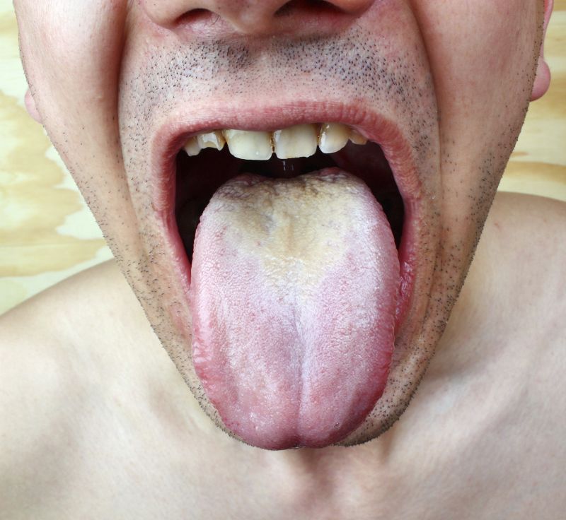 Dry Mouth And White Tongue 34
